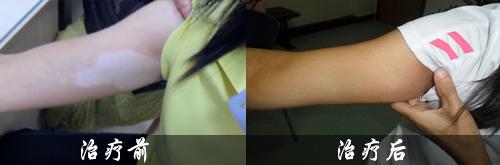 白癜风会传染吗？